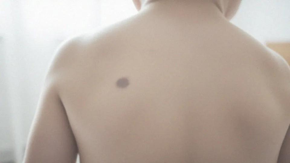 Dlaczego pojawiają się znamiona błękitne?